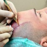 Is FUSS Hair Transplant Effective for Fixing a Receding Hairline