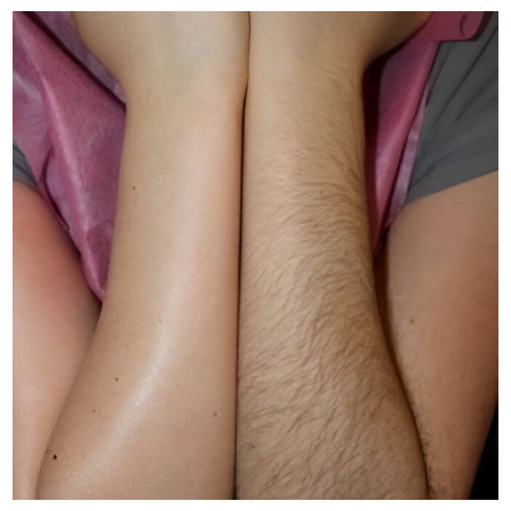 laser hair removal (1)