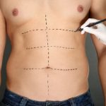 جراحة شفط الدهون في دبي