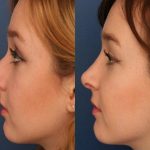 تجميل الأنف في دبي