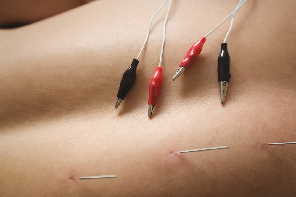 electro acupuncture