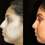 تجميل الأنف في دبي