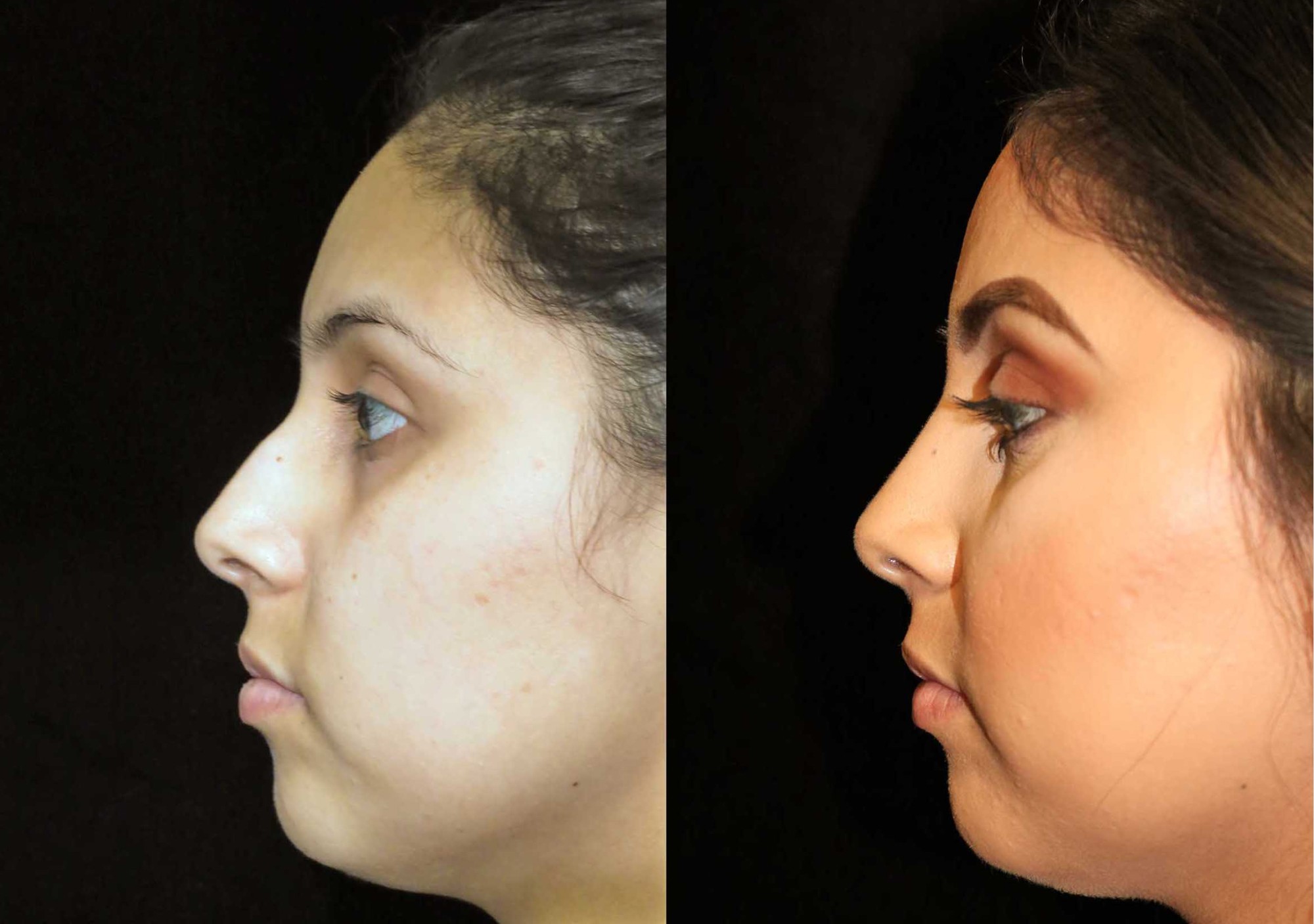 تجميل الأنف في دبي