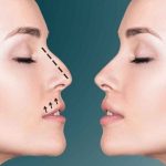 تجميل الأنف في دبي