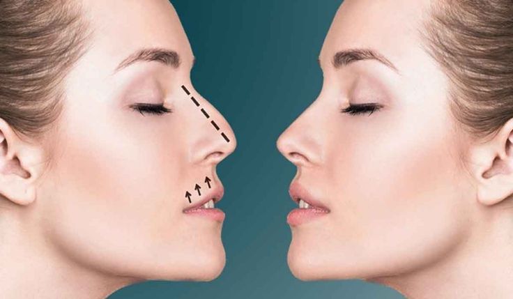 تجميل الأنف في دبي